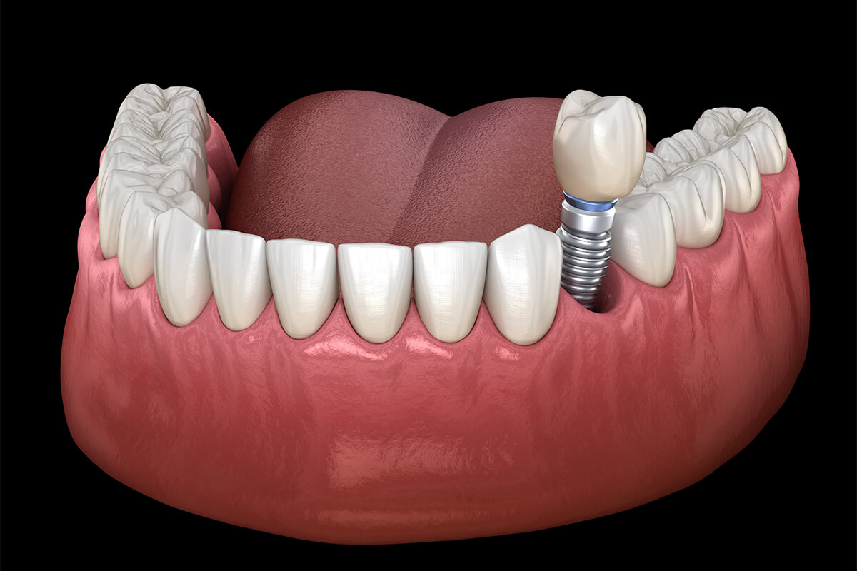 Implants Full Mouth Restoration in St. George UT Area